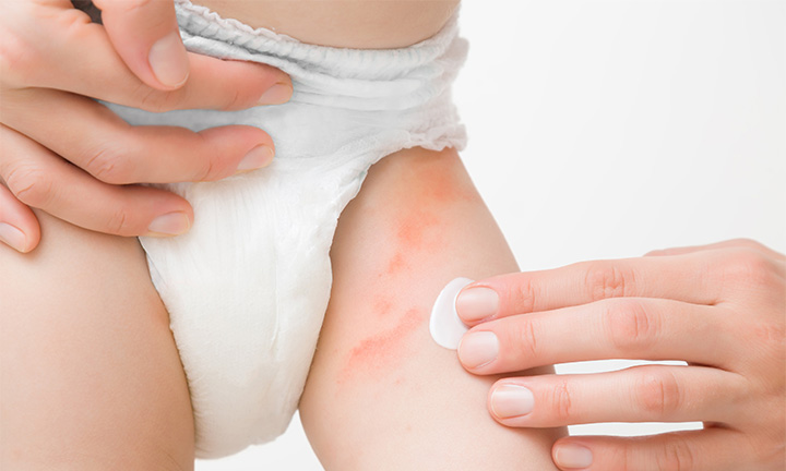 How to Apply Diaper Rash Cream 